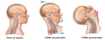Chấn thương cổ - Hình ảnh minh họa